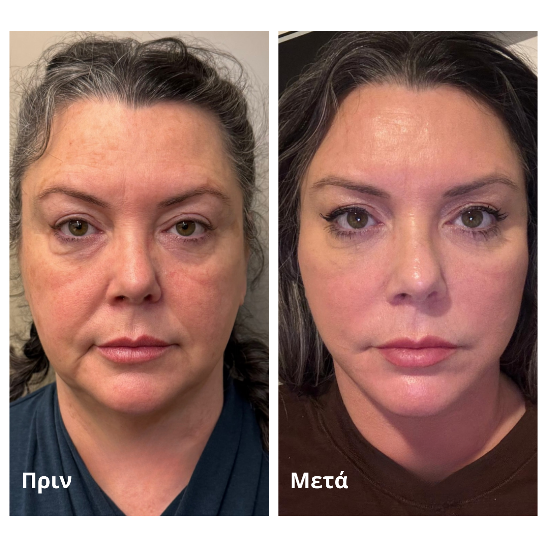 Βούρτσα Προσώπου Kalea για Λεμφική Σμίλευση